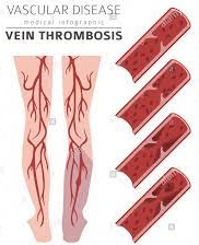 Thrombophlebitis