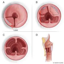 Traceal stenosis