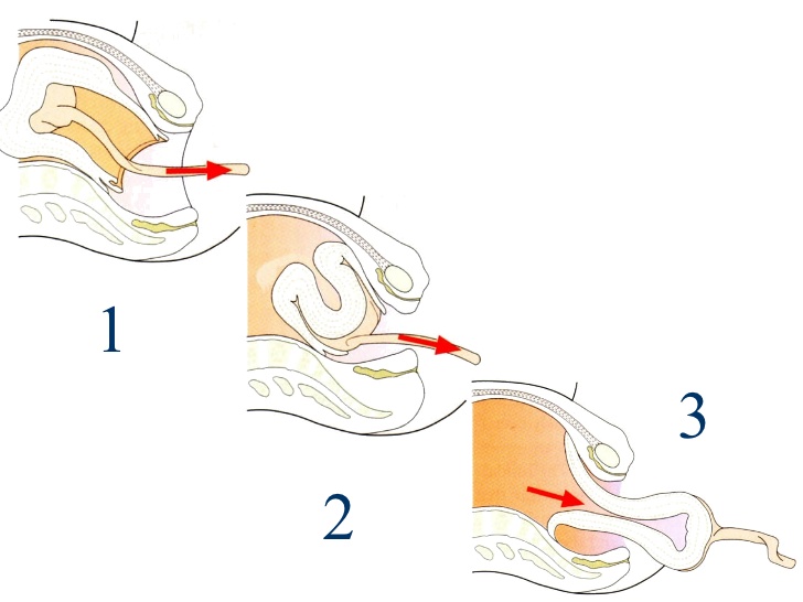 Uterine inversion