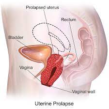 Uterine proplase