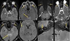 Uveomeningoencephalitic syndrome