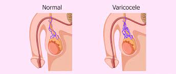 Varicocele