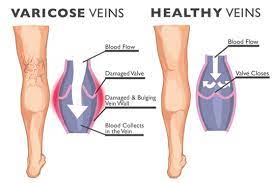 Varicose veins ( Varises )