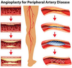 Vascular disease