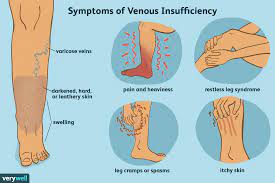 Venous insufficiency