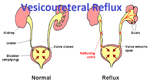 Vesico ureteral reflux